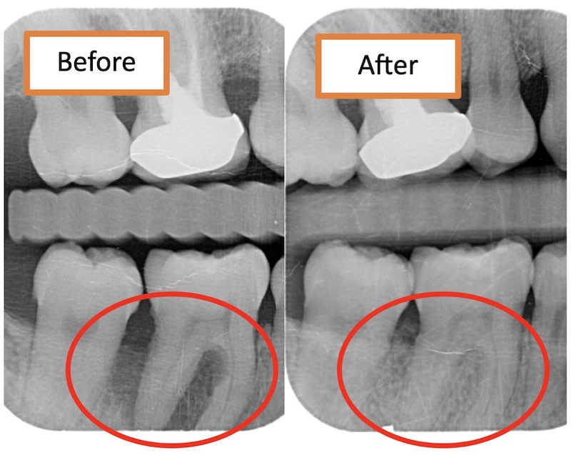 嚴重牙周病治療前後X光片對比