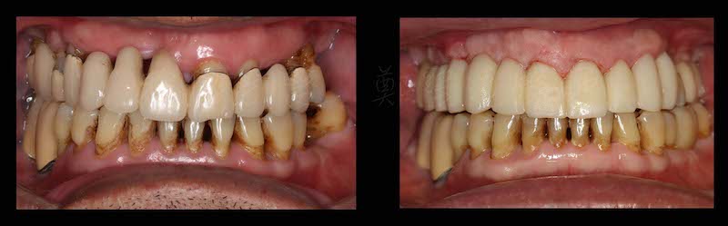 嚴重牙周病治療前後牙齒對比