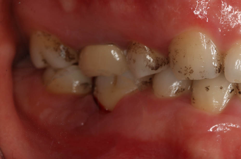 嚴重牙周病治療-水雷射牙周病-牙周再生手術-台北牙周病-推薦-鄭聖達醫師