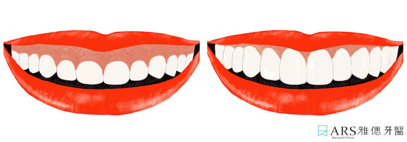 一般的牙齦過多，我們稱為露齦笑，這樣的笑容不好看，面相學上也不好。在美學的設計上我們會透過牙冠增長術來做改善