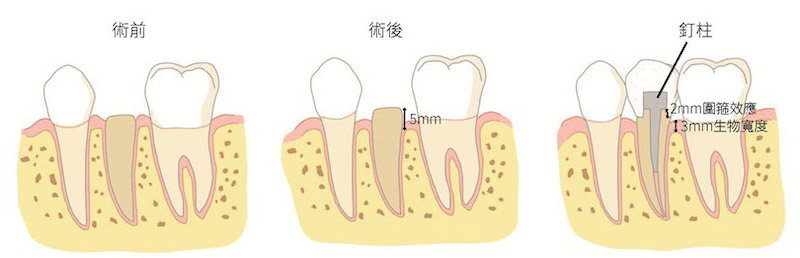 牙冠增長術後剩餘齒質有1.5~2mm的高度(圍箍效應)，與至少2mm的生物寬度