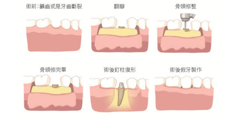 當臨床牙冠太短不足以製作假牙時，應先執行牙冠增長術爭取足夠的圍箍效應