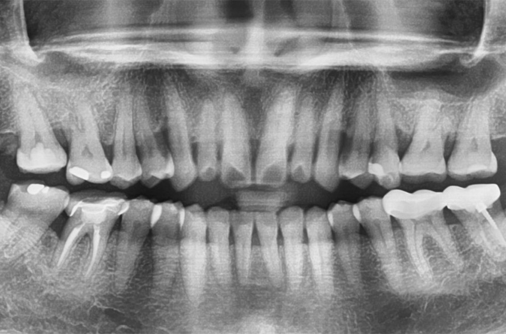 牙周病治療-水雷射-牙周再生手術-台北牙周病-推薦-鄭聖達醫師