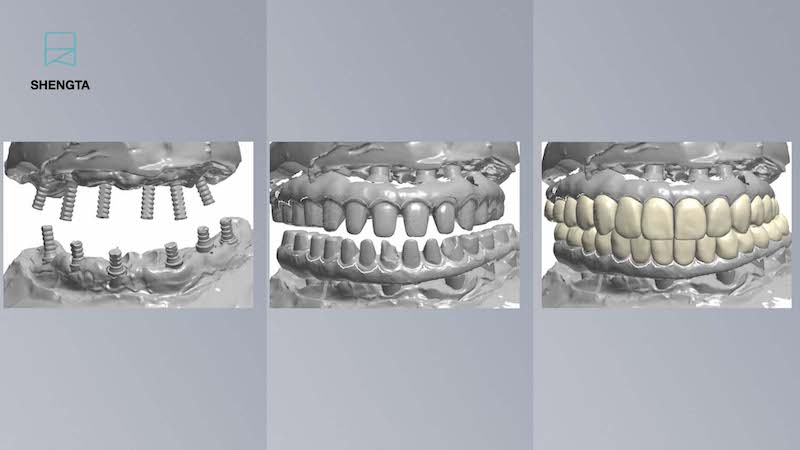 All-on-6-全口重建手術記錄-上下顎氧化鋯設計圖