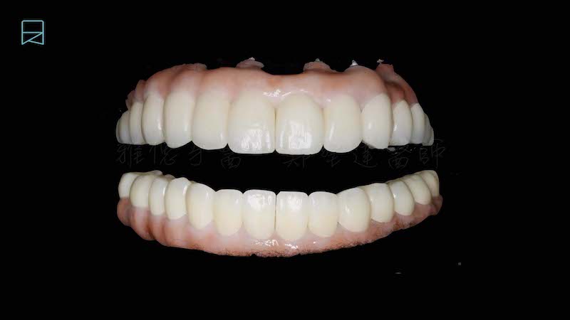 All-on-6-全口重建手術記錄-假牙試戴在支台齒上的狀況
