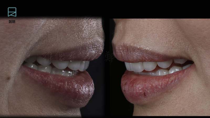 All-on-6-全口重建手術記錄-在口內試戴假牙