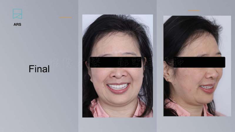 All-on-6-全口重建手術記錄-患者裝假牙後的臉型外觀