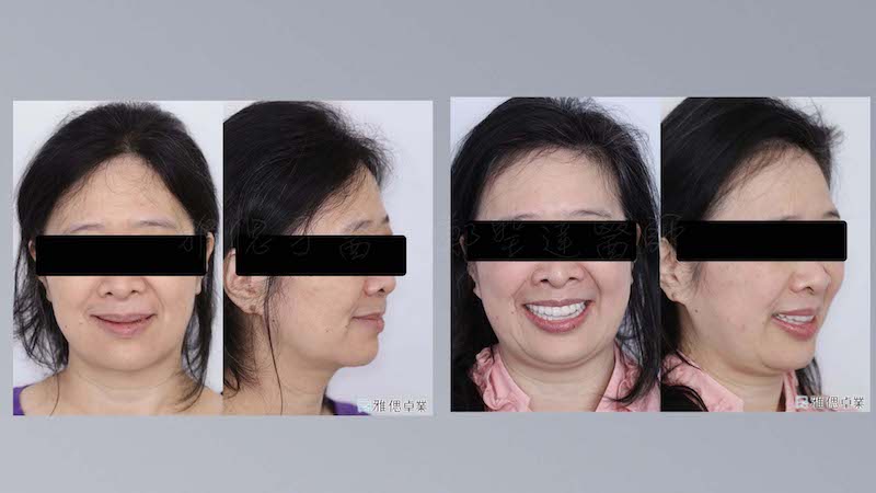 All-on-6-全口重建手術記錄-患者裝假牙後的臉型外觀