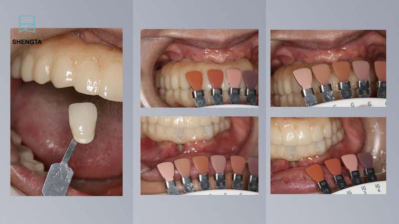 All-on-6-全口重建手術記錄-新的臨時牙橋-牙齒與牙齦比色