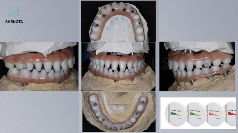 All-on-6-全口重建手術記錄-氧化鋯支台齒型態