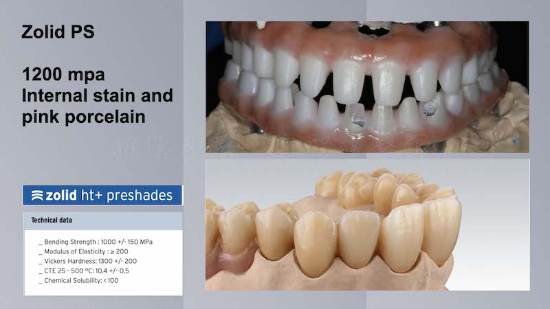 All-on-6-全口重建手術記錄-選用德制Zolid-PS高強度氧化鋯製作支台齒