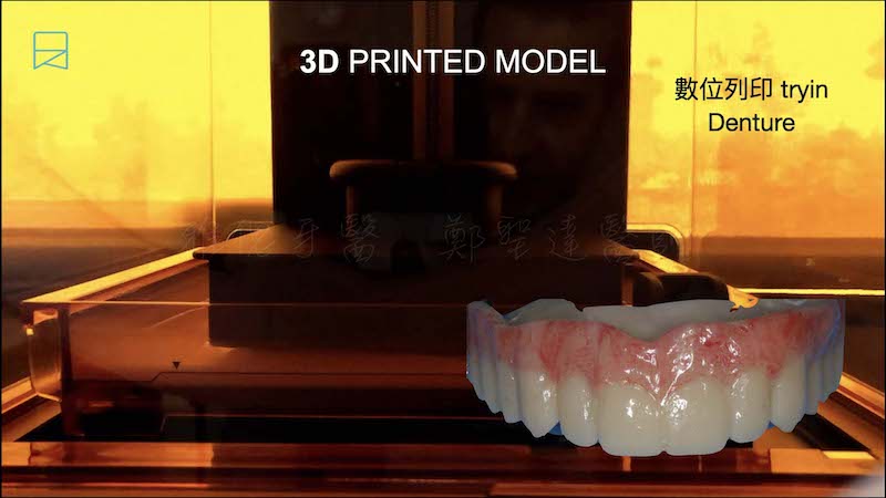 All-on-6-全口重建案例-嚴重牙周病-3D數位列印臨時假牙