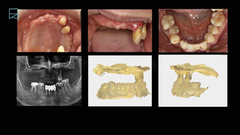All-on-6-全口重建案例-療程前-嚴重牙周病患者口內照與口掃模型