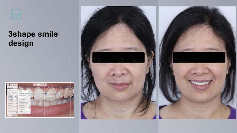 All-on-6-全口重建案例-療程前-嚴重牙周病患者臉型不對稱