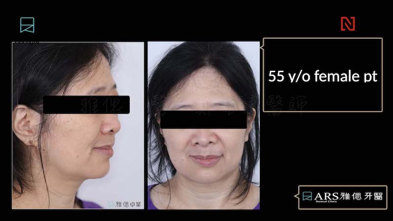 All-on-6-全口重建案例-療程前-嚴重牙周病患者臉型外觀