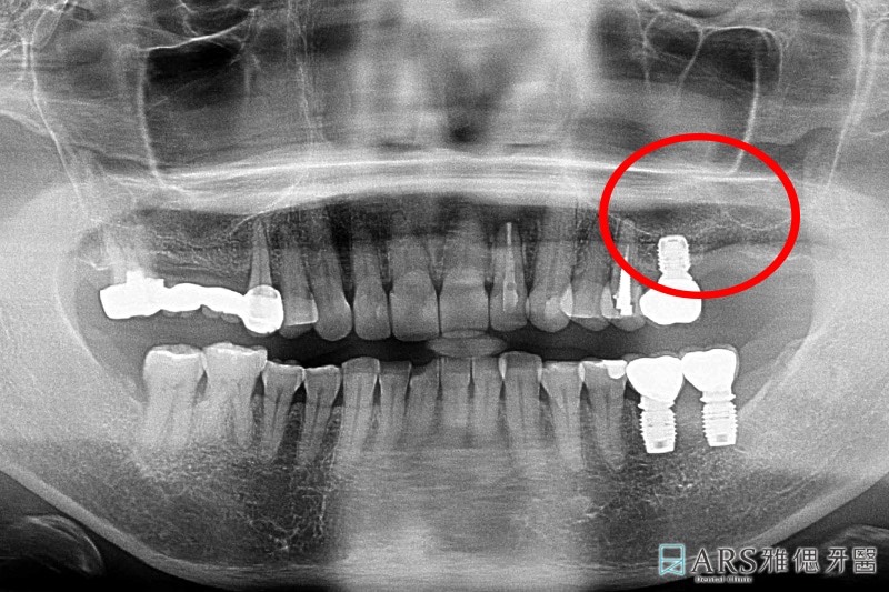 植牙補骨前，X光片顯示上顎缺牙處齒槽骨厚度不足，需進行鼻竇增高術並補骨