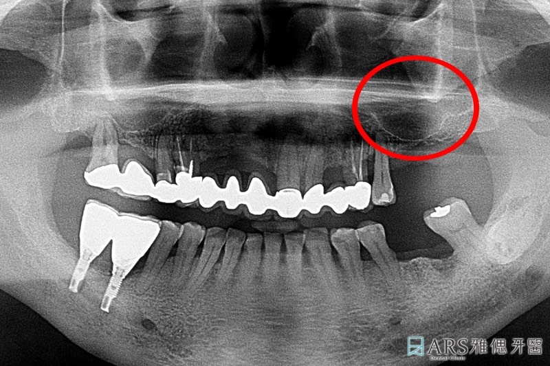 植牙補骨前X光片，上顎缺牙處齒槽骨流失導致厚度不足，需進行鼻竇增高術並補骨