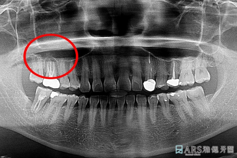 鼻竇增高術-植牙補骨-術前環口X光片