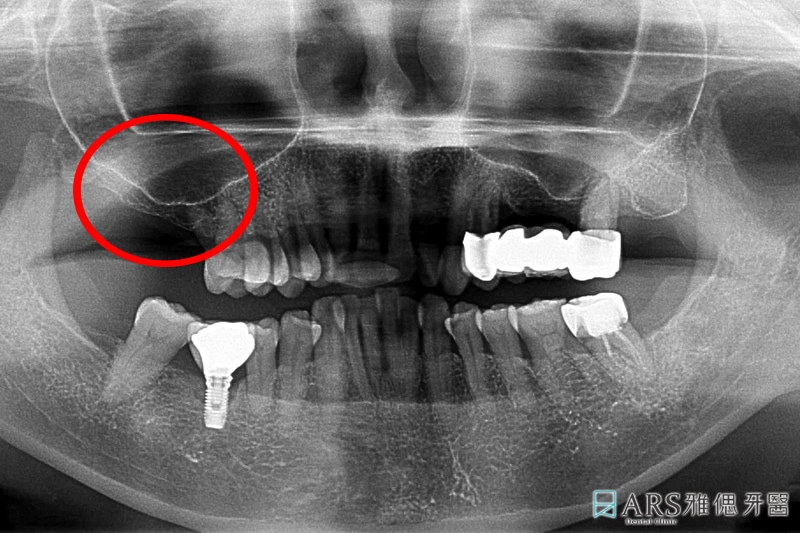 鼻竇增高術-植牙補骨-術前環口X光片