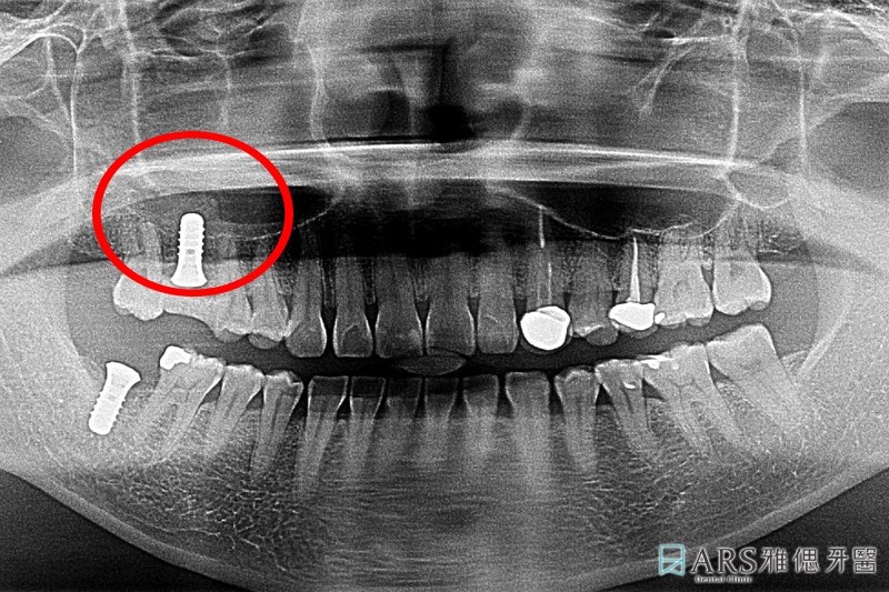 鼻竇增高術-植牙補骨-術後環口X光片
