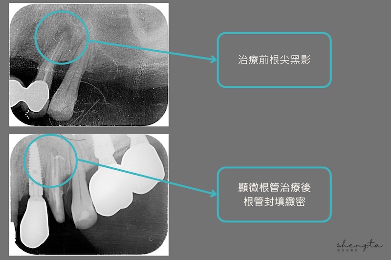 左上第一小臼齒在顯微根管治療前後的根尖X光片比較，治療後根管封填緻密