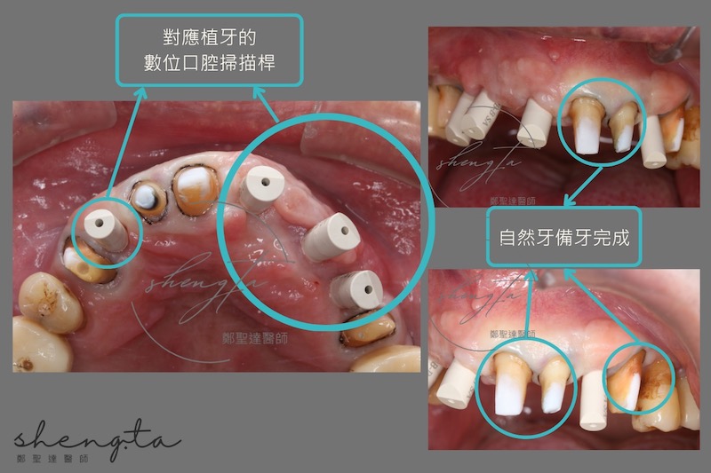 製作正式假牙前，透過對應植牙的口腔掃描桿進行數位口掃，並完成自然牙備牙