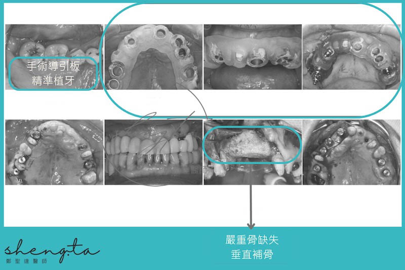於嚴重齒槽骨流失之處進行垂直補骨；製作手術導引板進行植牙