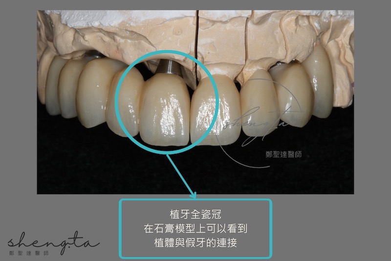 在牙膏模型上模擬植牙全瓷冠和全瓷冠牙套，可以看到植體與假牙的連結，整體外觀自然如真牙