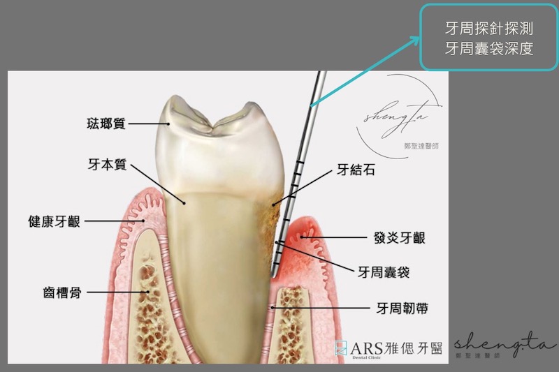嚴重牙周病治療前使用牙周探針探測牙周囊袋深度