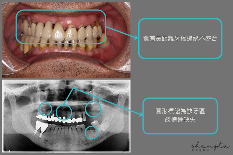 嚴重牙周病治療前口內照與環口X光片，有舊牙橋不密合、齒槽骨流失、缺牙等問題