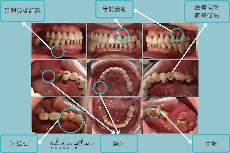 嚴重牙周病治療前收集的口腔照片，有牙垢、牙結石、牙齦發炎紅腫、牙齦萎縮、舊假牙破損、缺牙等情形