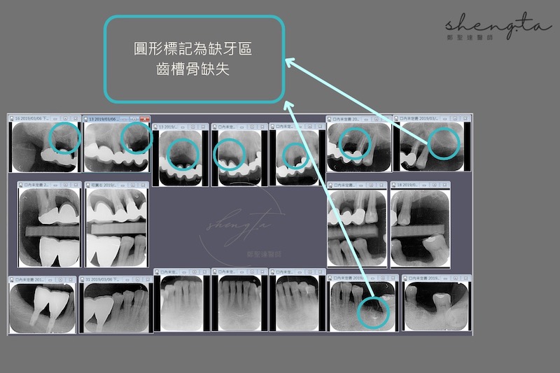 嚴重牙周病治療前收集完整的根尖X光片，有多處齒槽骨流失