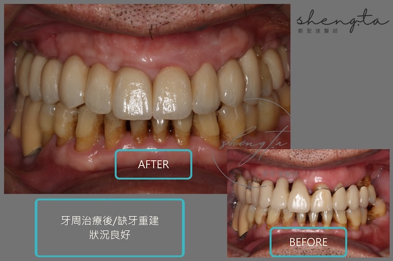 完成牙周病治療與植牙重建前後對比，恢復上排前牙美觀且狀況良好