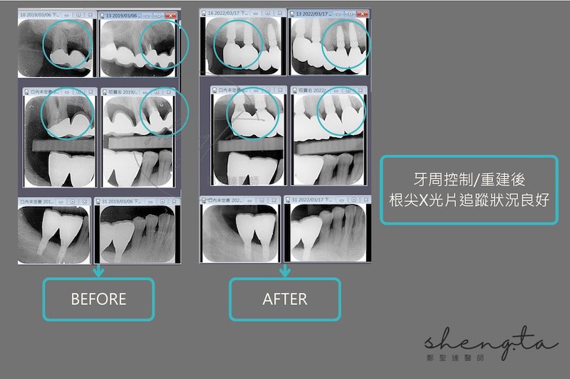 牙周病治療與植牙重建前後的根尖X光片比較，術後追蹤狀況良好