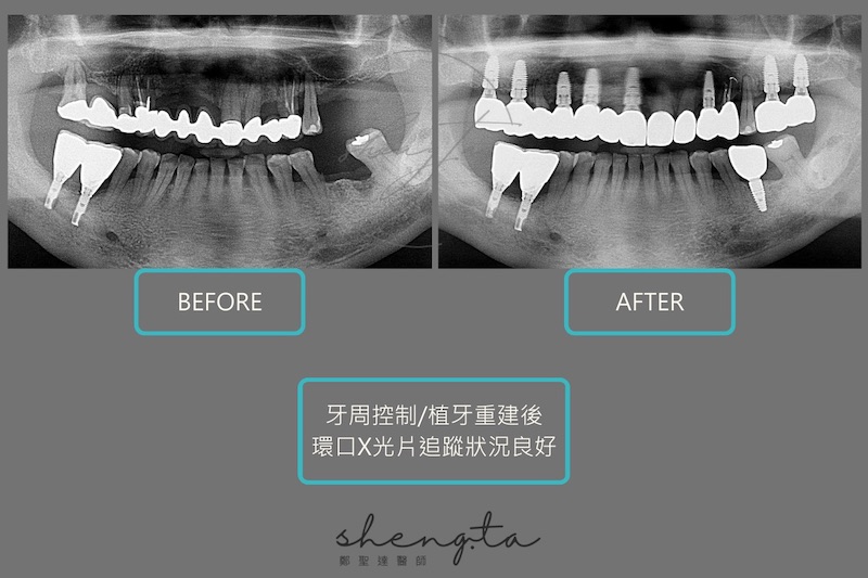 牙周病治療與植牙重建前後的環口X光片比較，術後追蹤狀況良好