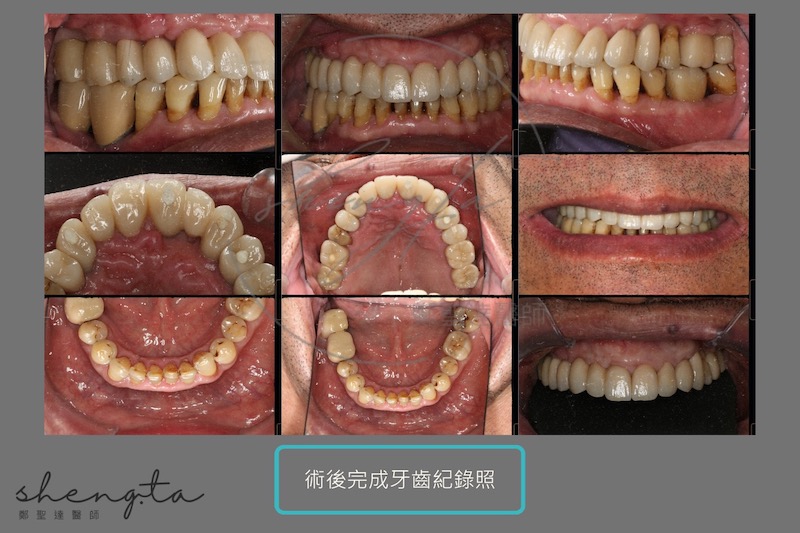 完成嚴重牙周病治療與植牙術後紀錄照，順利重建缺牙，牙周恢復健康