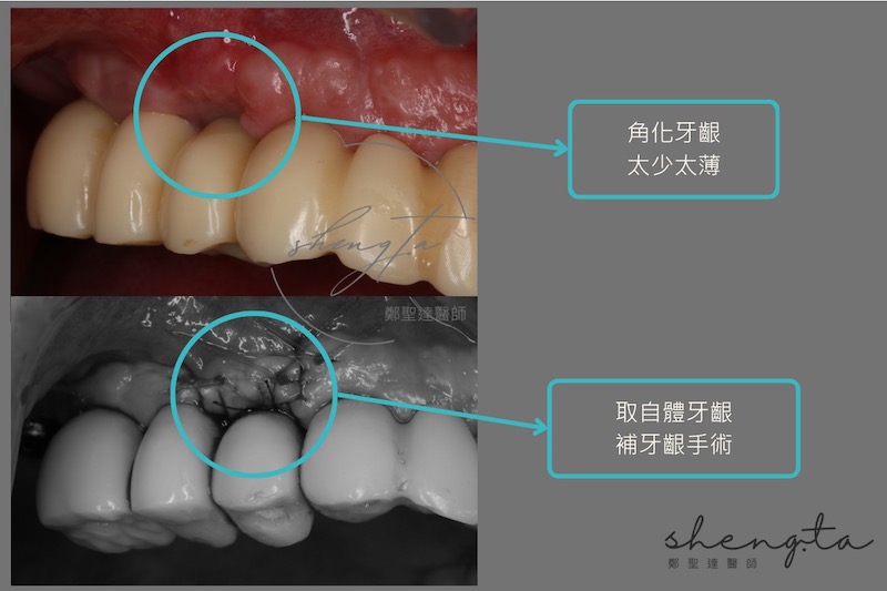 角化牙齦太少太薄，取自體牙齦進行補牙齦手術