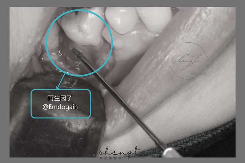 牙周再生手術中使用再生因子＠Emdogain牙釉基質蛋白