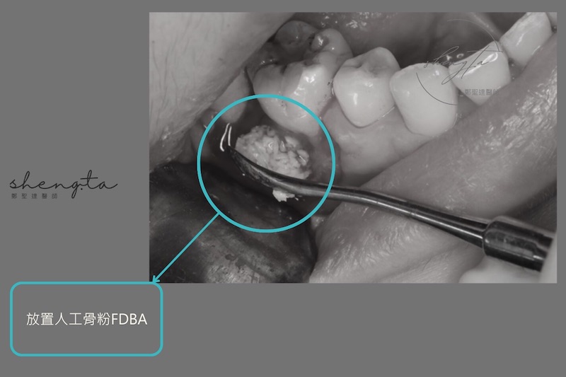 牙周再生手術中使用人工骨粉FDBA進行補骨