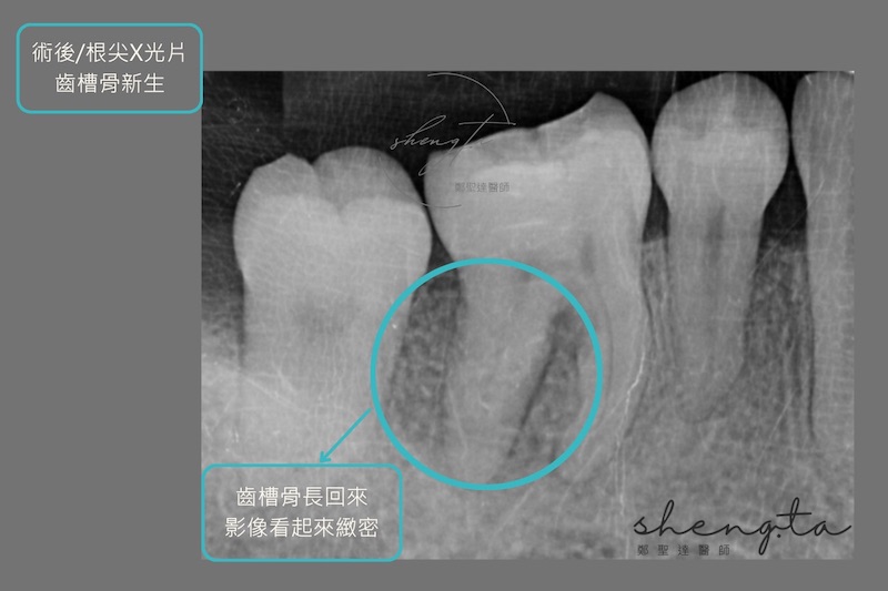 牙周再生手術術後根尖X光片，齒槽骨長回來，影像看起來緻密