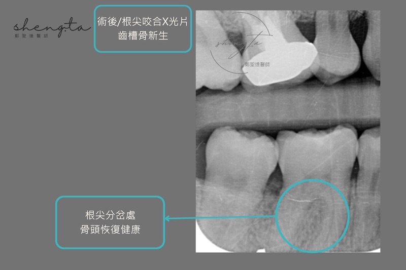 牙周再生手術術後根尖X光片，齒槽骨長回來，根尖分岔處骨頭恢復健康