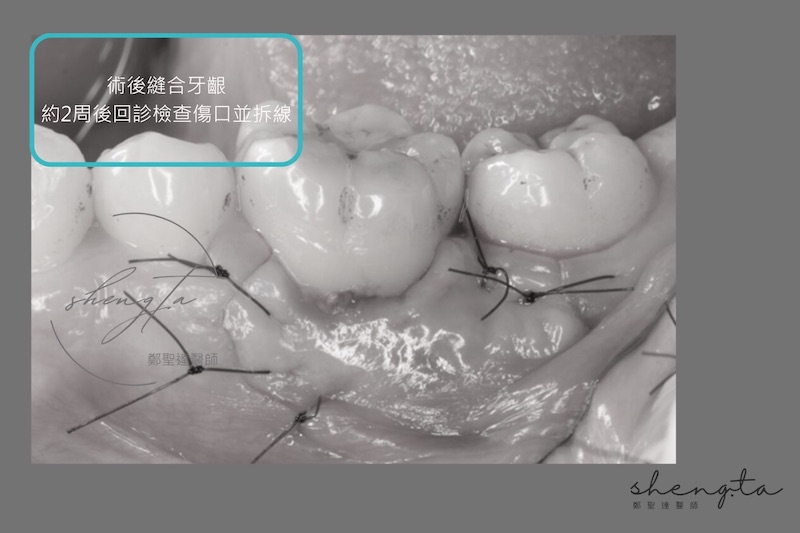 牙周再生手術術後縫合牙齦，約2周後回診檢查傷口並拆線