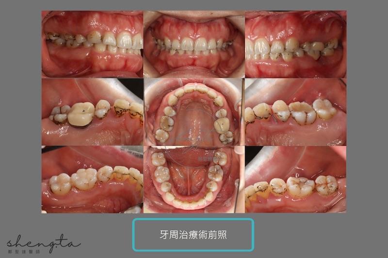 嚴重牙周病治療前口腔照片紀錄