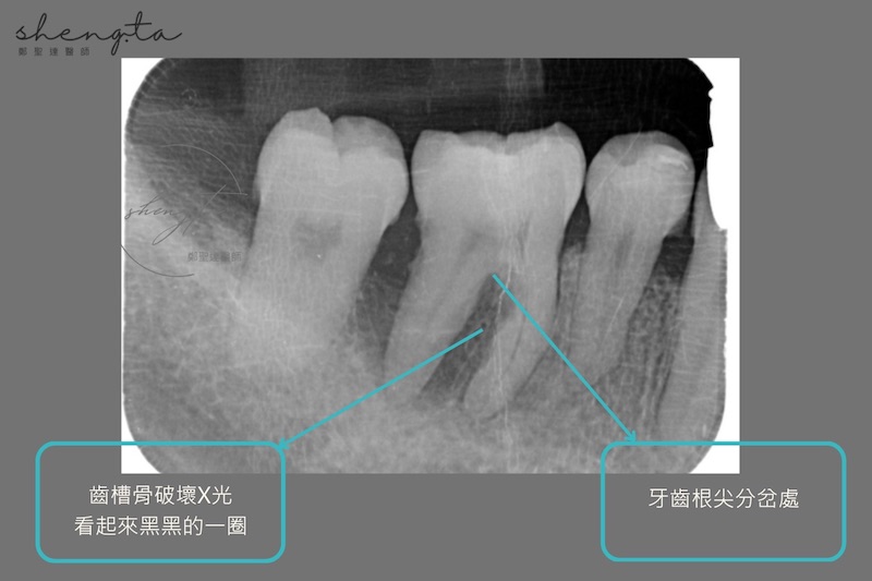 嚴重牙周病治療前，根尖X光片顯示齒槽骨流失破壞