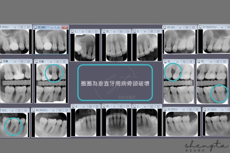 嚴重牙周病治療前，根尖X光片顯示全口有多處垂直齒槽骨破壞