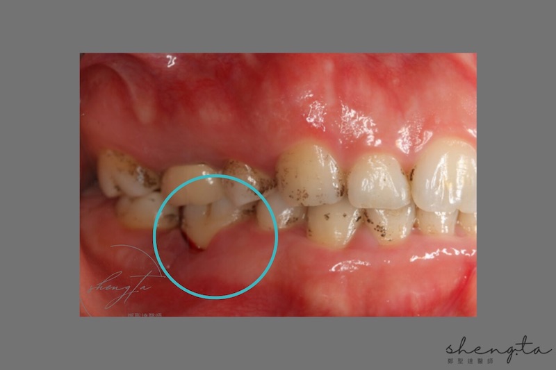 嚴重牙周病治療前，右下第一大臼齒牙齦紅腫發炎