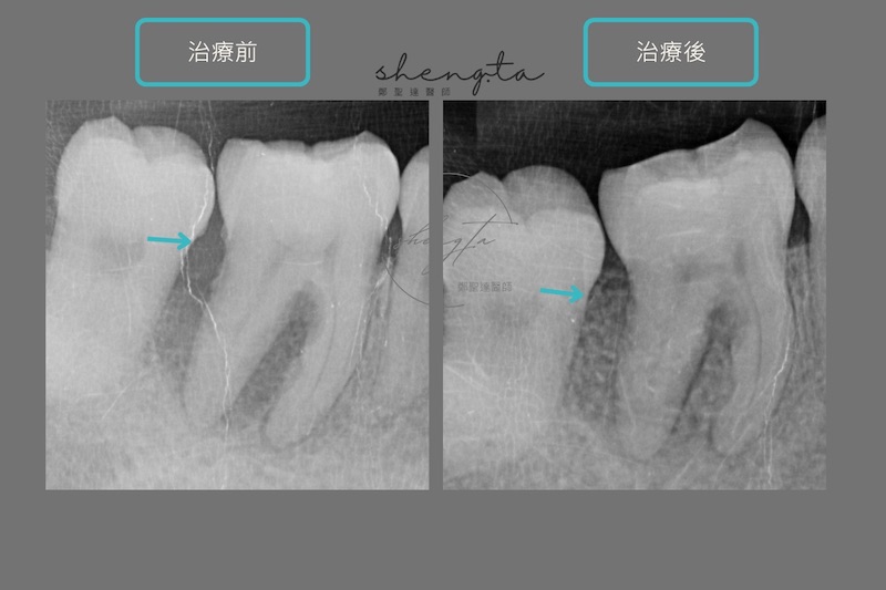 嚴重牙周病治療前齒槽骨流失，經水雷射治療、牙周再生手術後可見骨頭新生