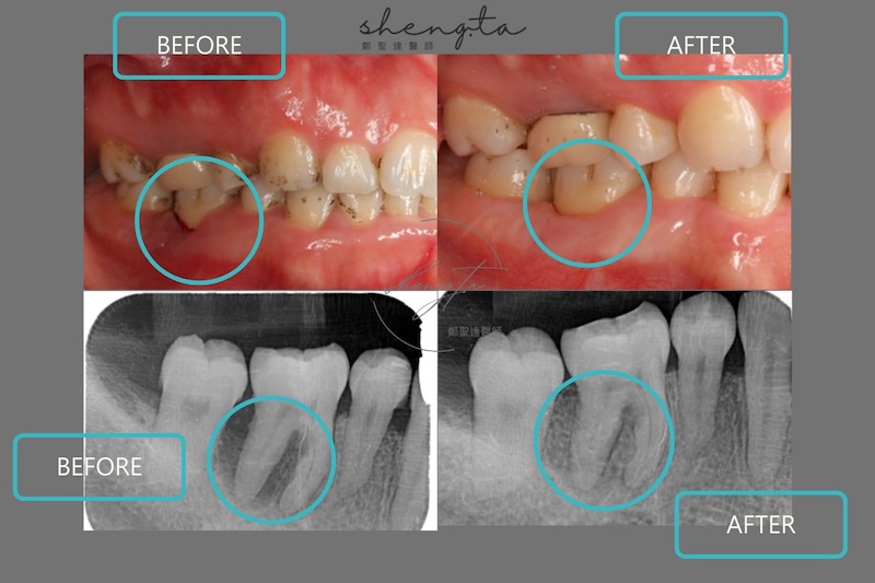 嚴重牙周病治療前後對比，經水雷射治療、牙周再生手術後改善牙齦萎縮且骨頭狀況穩定