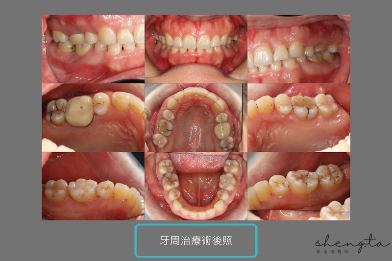 嚴重牙周病治療後口腔照片紀錄