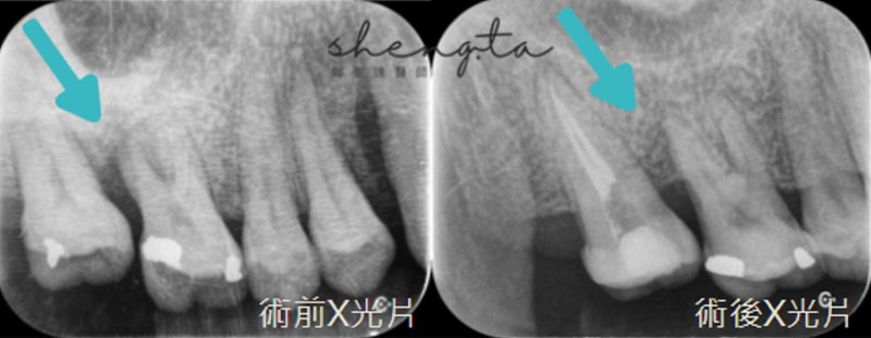 完成牙周再生手術補骨及根管治療，右上區域治療前後對比，可見齒槽骨再生